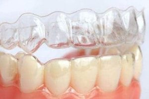 Aparelho dental Invisalign em Maringá