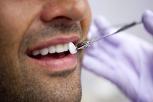 Lente dental em Maringá